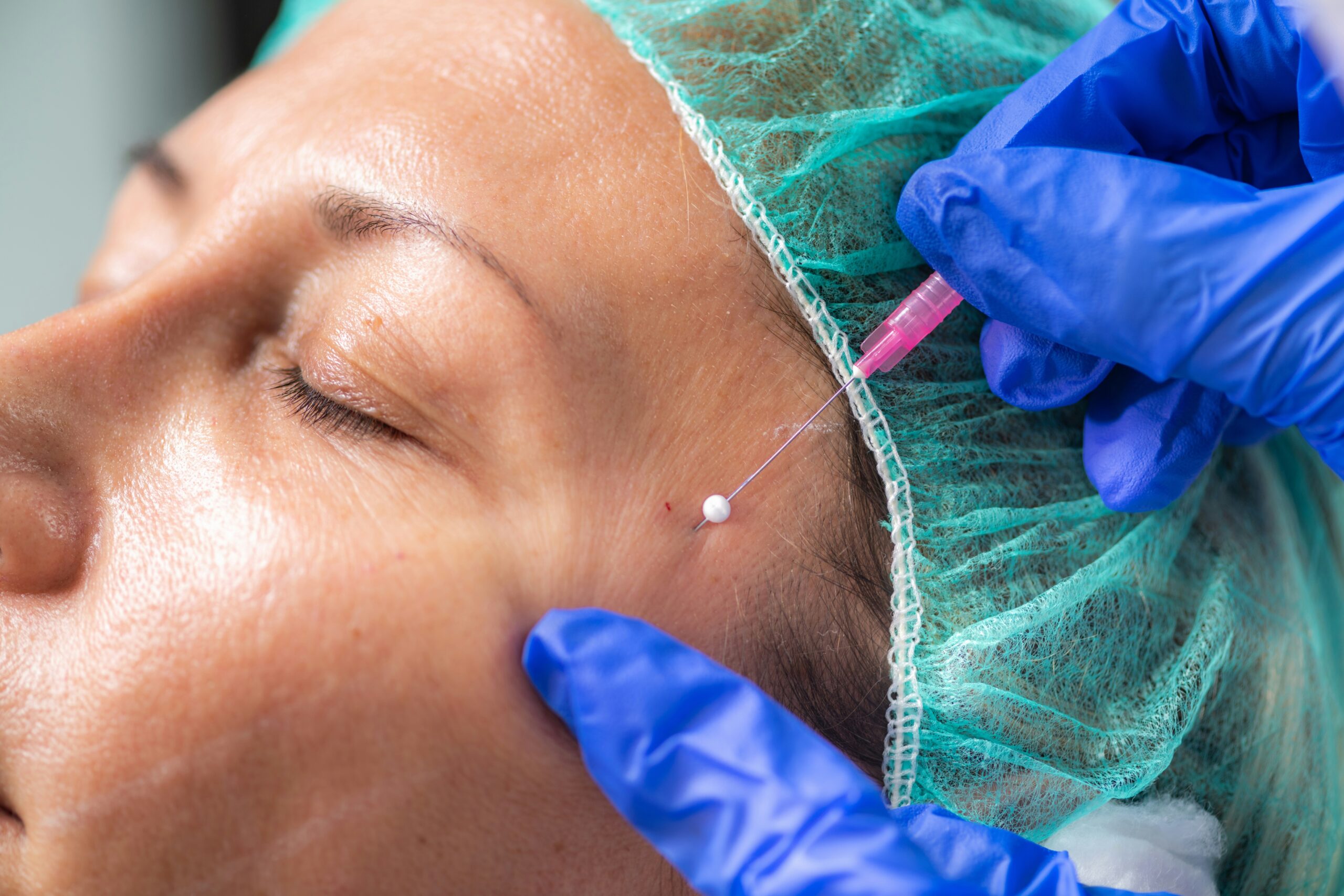 A woman receiving a thread lift procedure on her face.